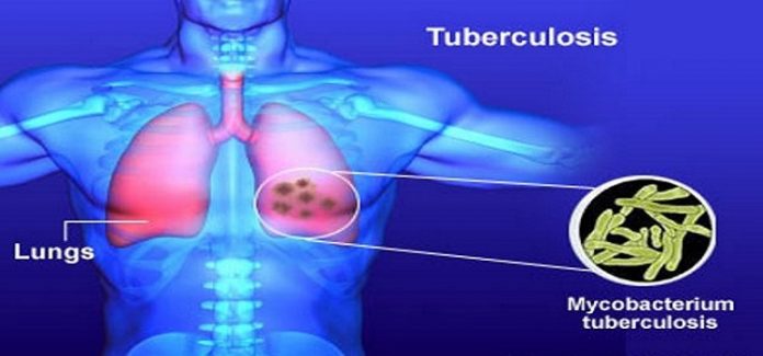 tuberculosis-tb